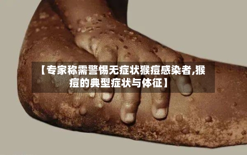 【专家称需警惕无症状猴痘感染者,猴痘的典型症状与体征】-第2张图片