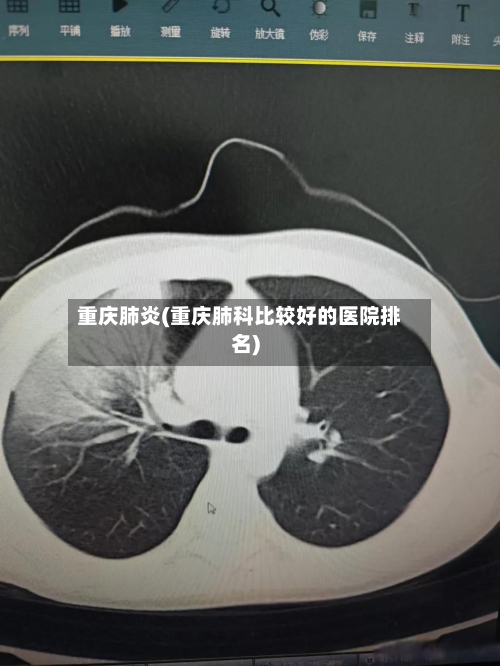 重庆肺炎(重庆肺科比较好的医院排名)