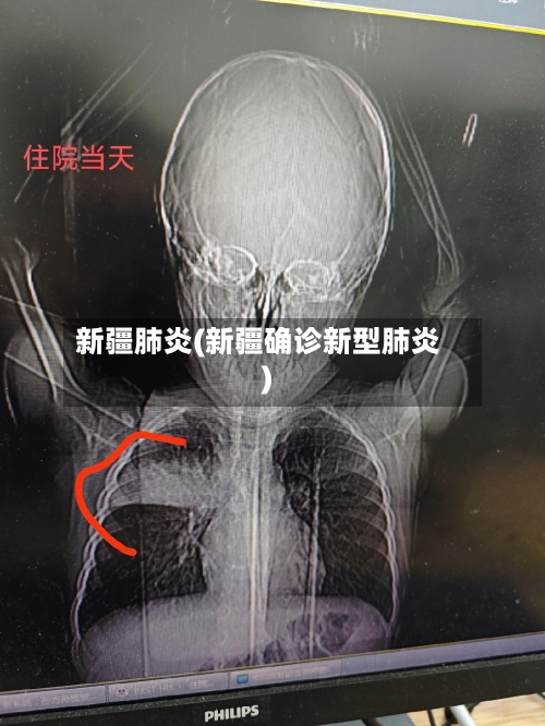 新疆肺炎(新疆确诊新型肺炎)-第2张图片