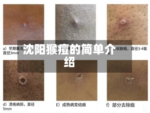 沈阳猴痘的简单介绍