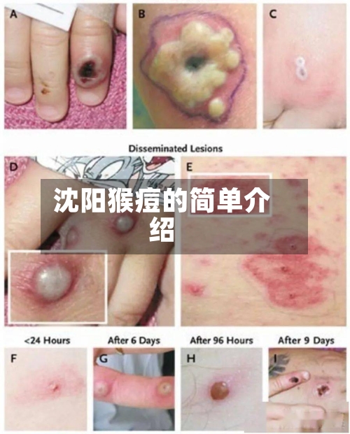 沈阳猴痘的简单介绍-第3张图片