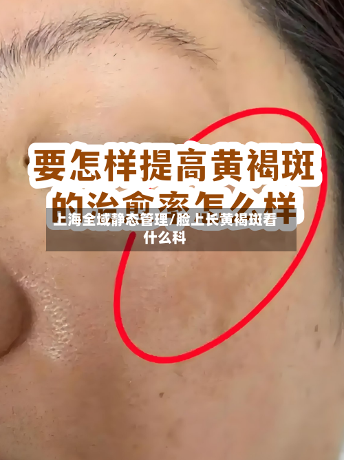 上海全域静态管理/脸上长黄褐斑看什么科
