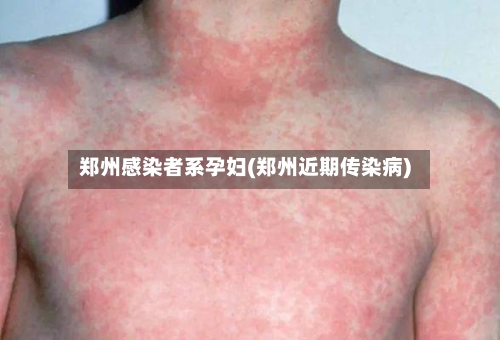 郑州感染者系孕妇(郑州近期传染病)-第2张图片
