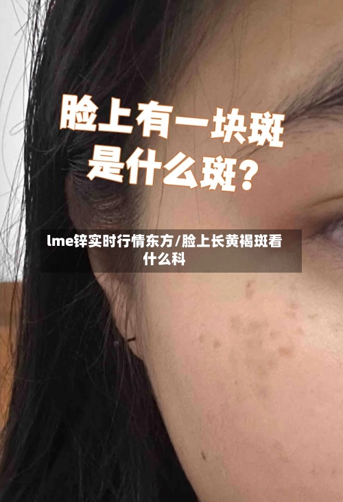 lme锌实时行情东方/脸上长黄褐斑看什么科-第2张图片