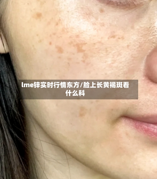 lme锌实时行情东方/脸上长黄褐斑看什么科