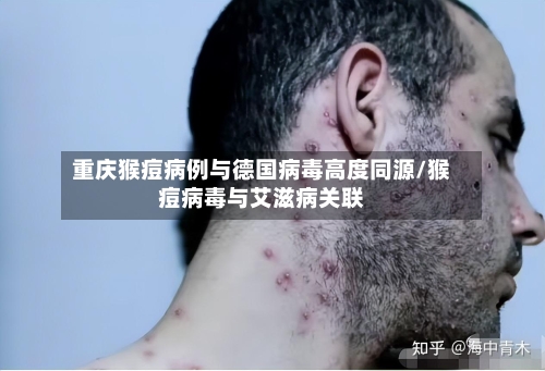 重庆猴痘病例与德国病毒高度同源/猴痘病毒与艾滋病关联-第2张图片