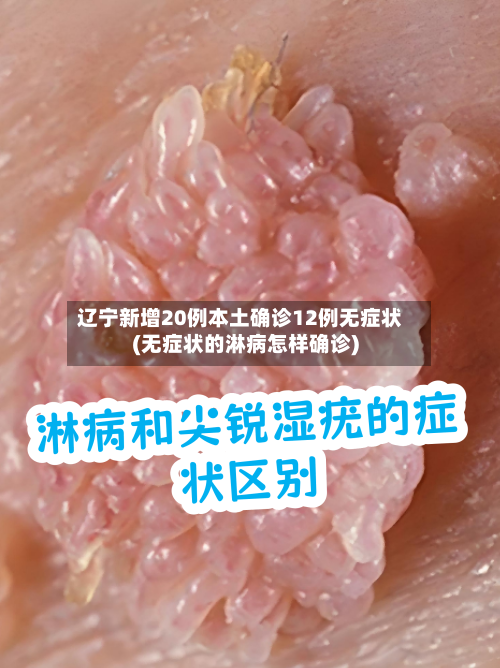 辽宁新增20例本土确诊12例无症状(无症状的淋病怎样确诊)