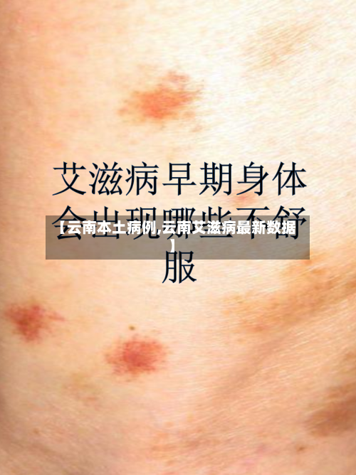 【云南本土病例,云南艾滋病最新数据】-第2张图片