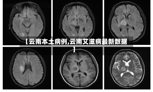 【云南本土病例,云南艾滋病最新数据】-第3张图片
